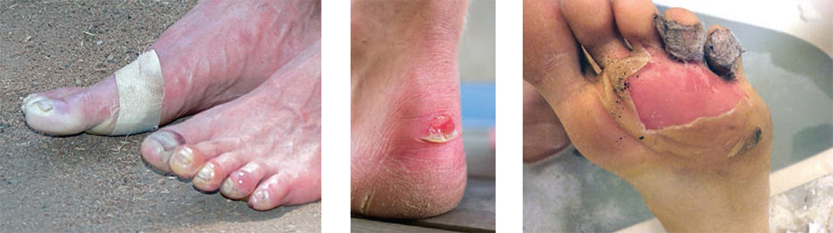 Foot Blisters